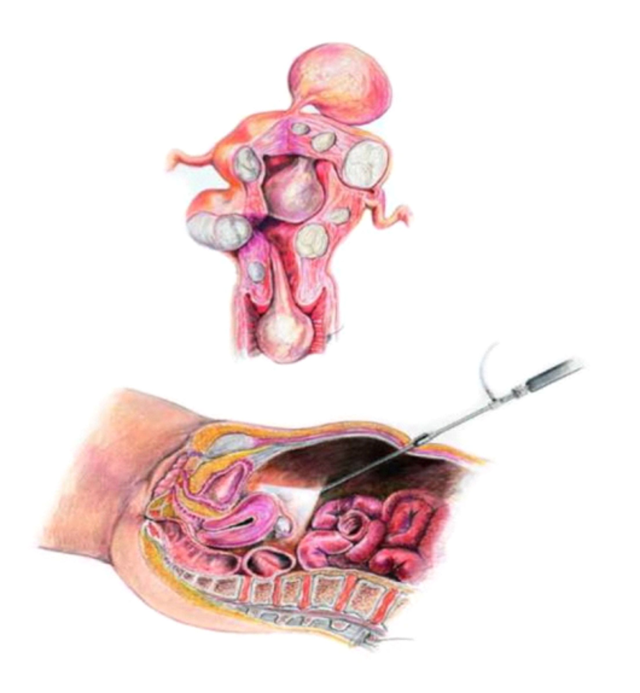 Dr Duarte Miguel Ribeiro - Figura superior mostrando diferentes tipos de miomas uterinos